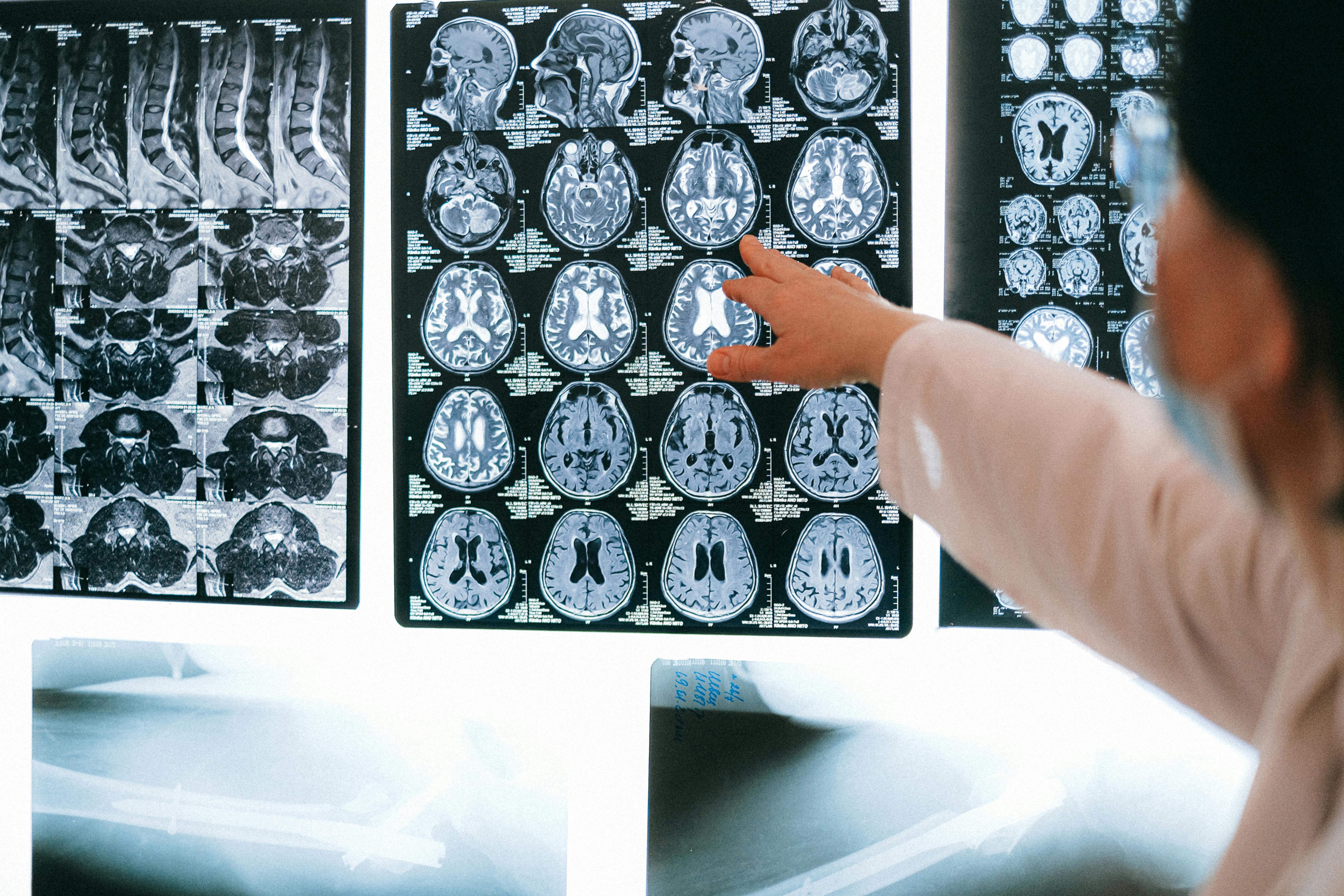 8 moduri de a reduce riscul de accident vascular cerebral. sursa foto pexels.com