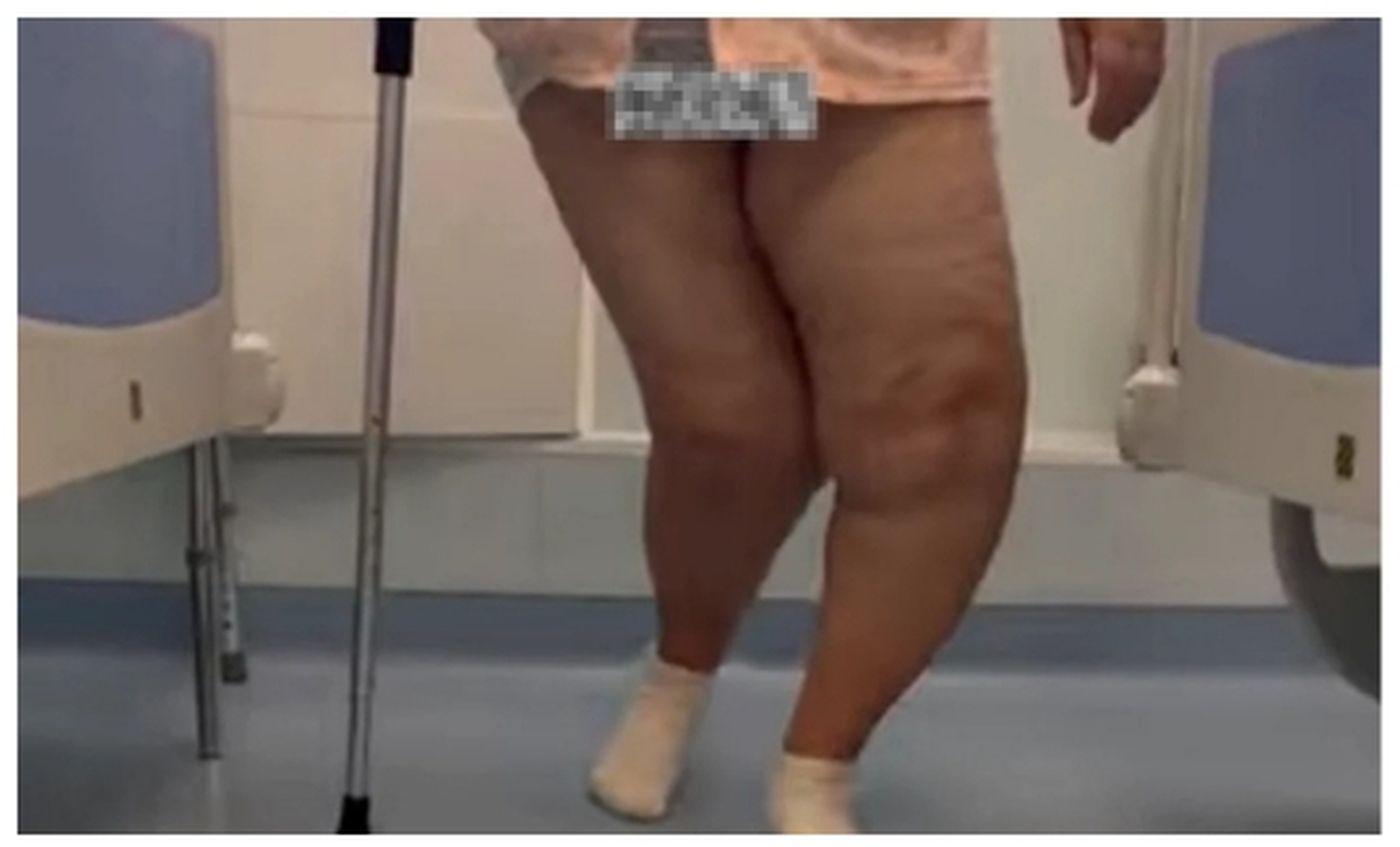 Genunchi deformați în laterale: care e cauza lor? sursa foto capturi Youtube