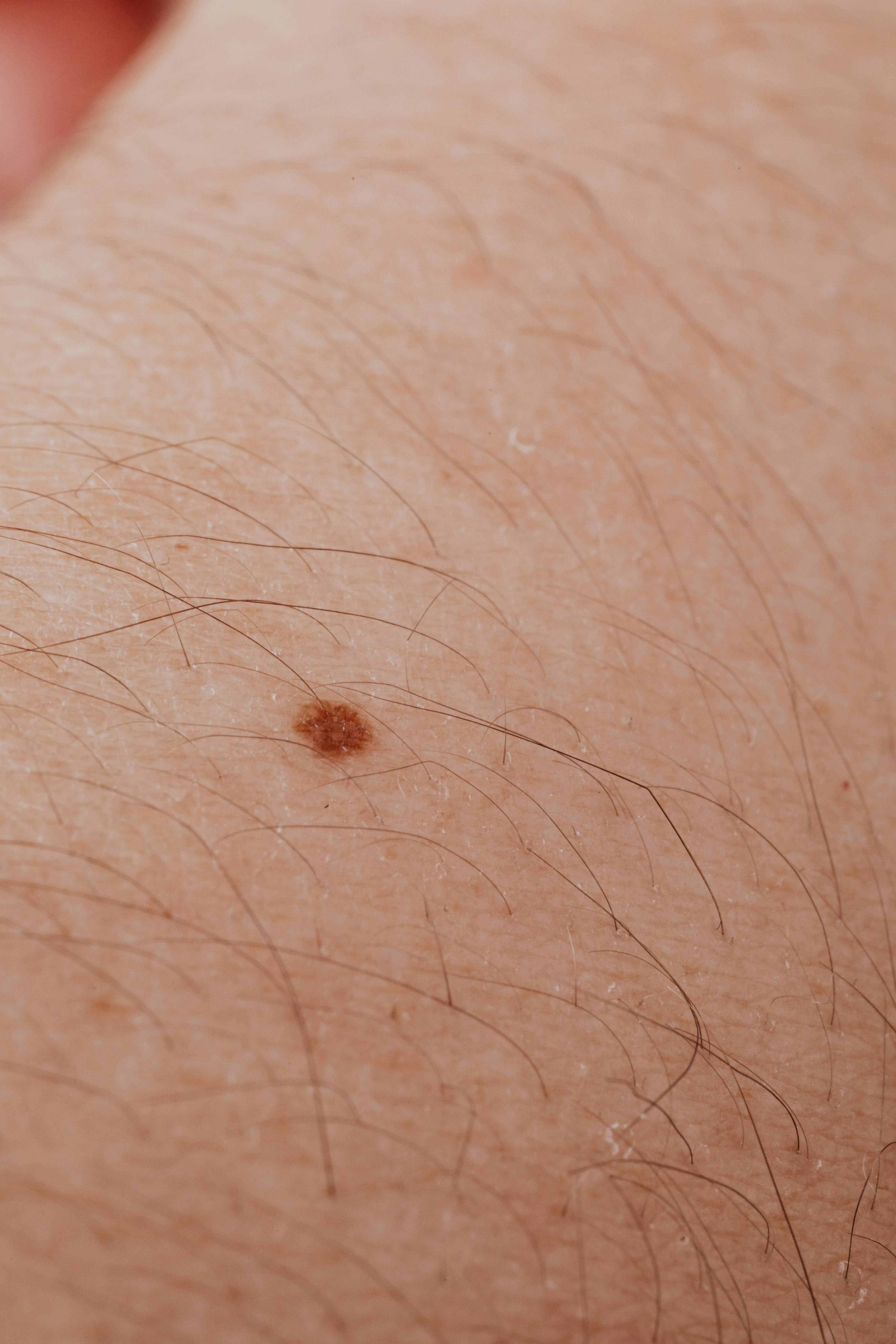 Un pistrui s-a transformat într-un nodul canceros. sursa foto freepik.com