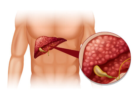 6 semne ale cancerului pancreatic pe care nu trebuie să le ignori