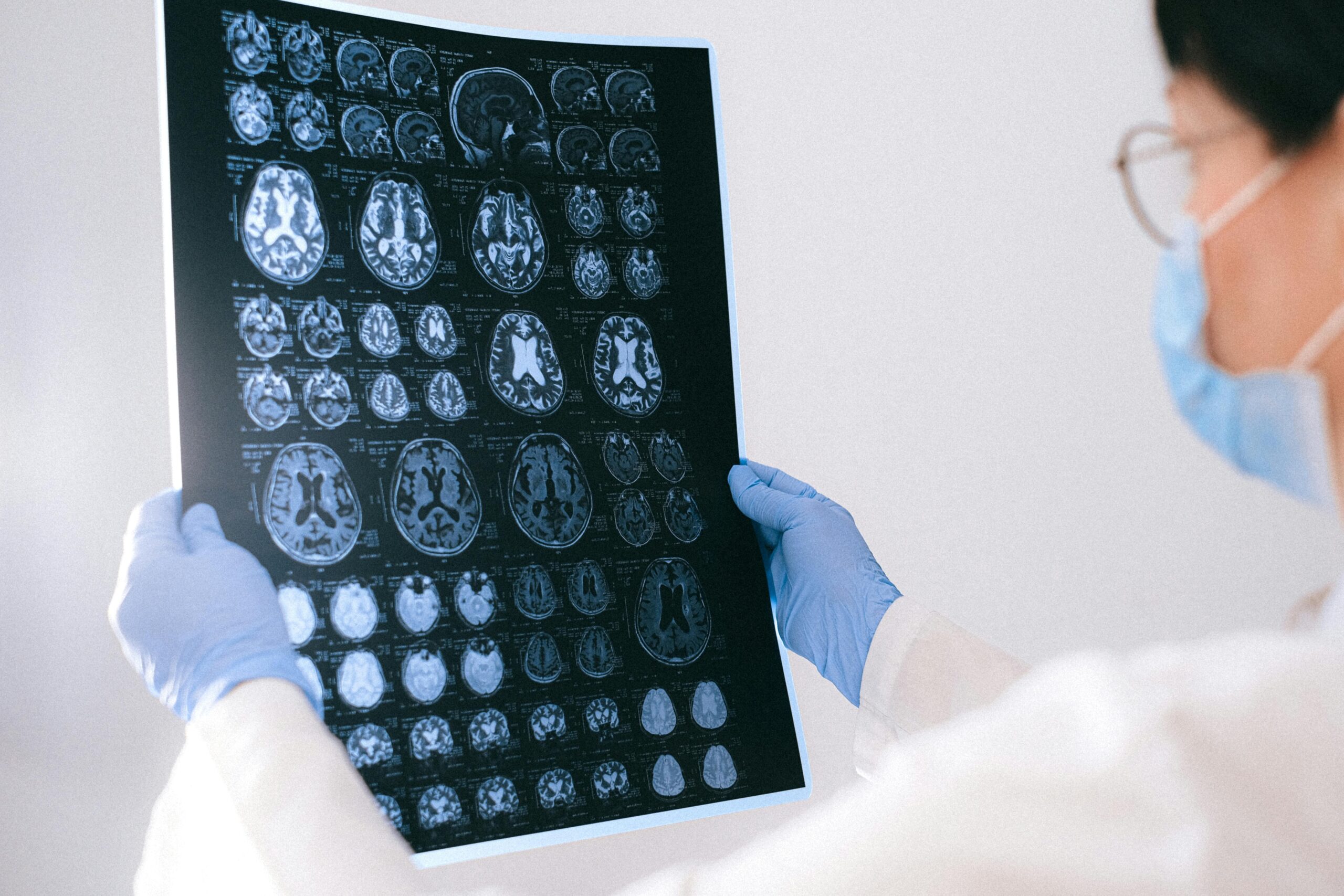 Ce se întâmplă cu creierul afectat de alzheimer. sursa foto pexels.com