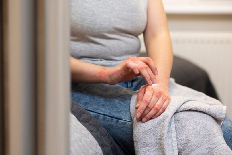 A fost confirmat un caz de lepră în România