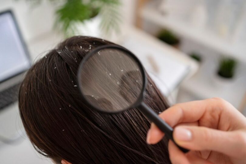 Ce este ciuperca Malassezia și cum afectează scalpul