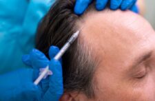 Acest tratament injectabil ajută la creșterea foliculilor de păr. Ar putea vindeca permanent chelia, spun experții