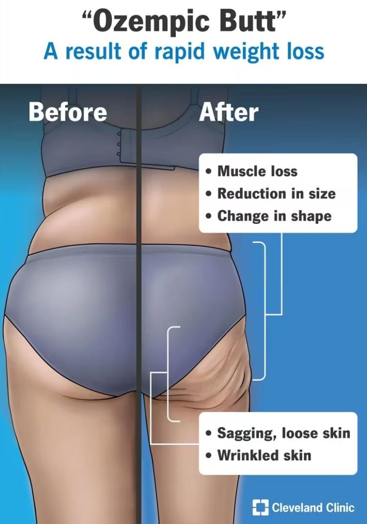 Slăbitul rapid poate duce la piele lăsată și pierdere de masă musculară în zona feselor. foto: Cleveland Clinic