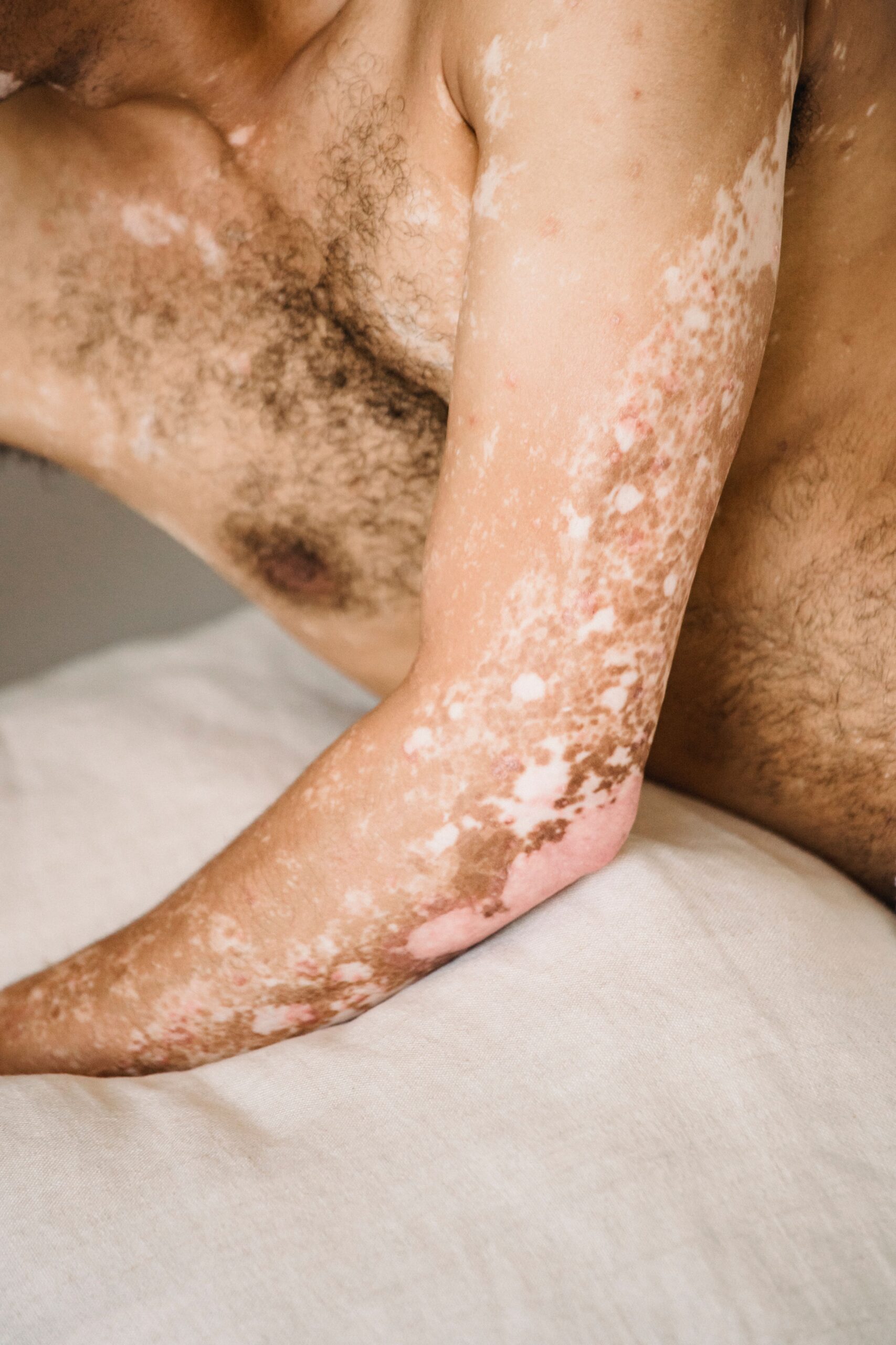 Dermatofiloza este o infecție a pielii provocată de bacteria Dermatophilus congolensis. Foto: pexels.com