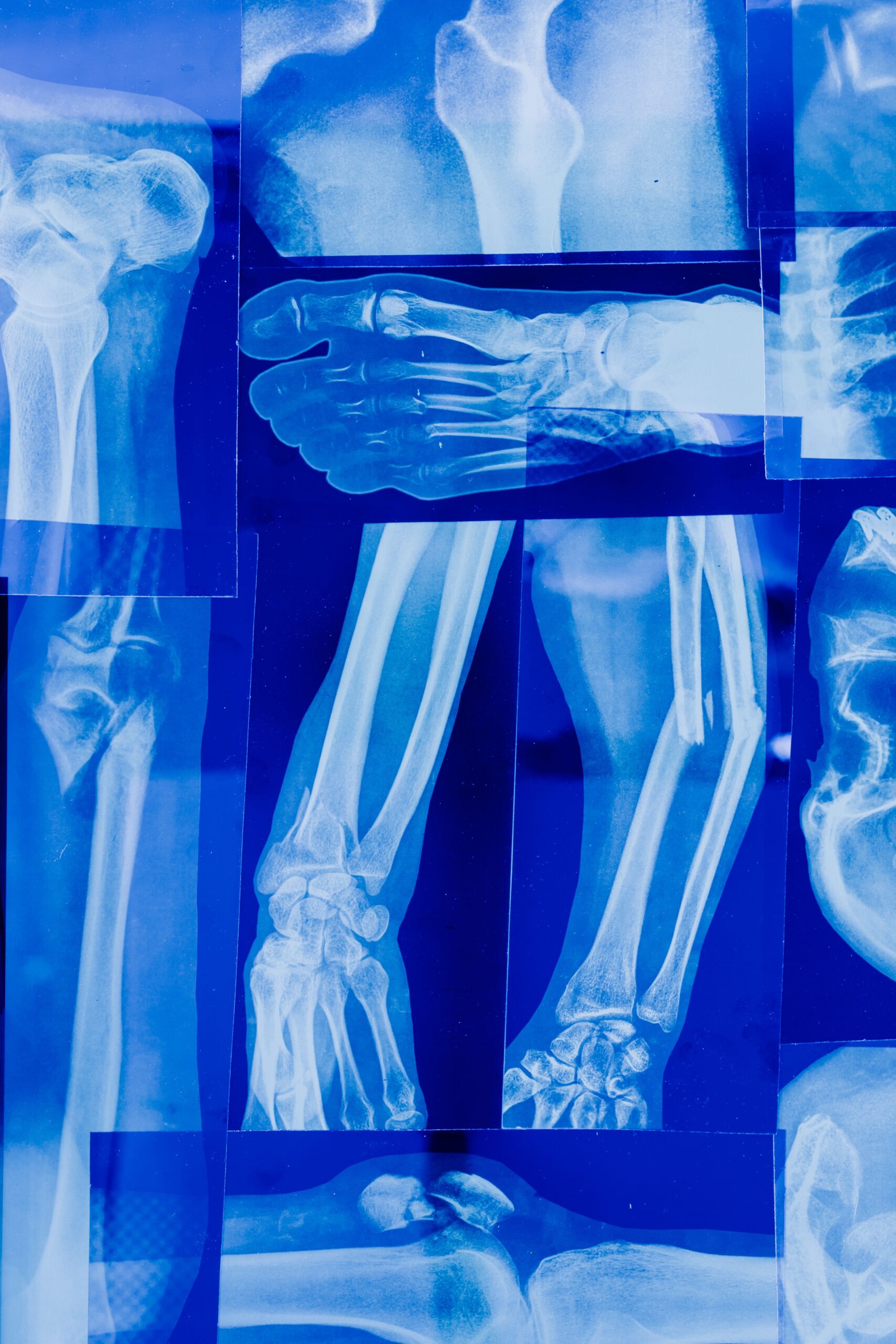 Osteoporoza este o afecțiune care poate evolua mult timp fără simptome evidente. Foto: pexels.com